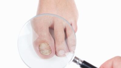 Comment traiter un champignon sur le pouce