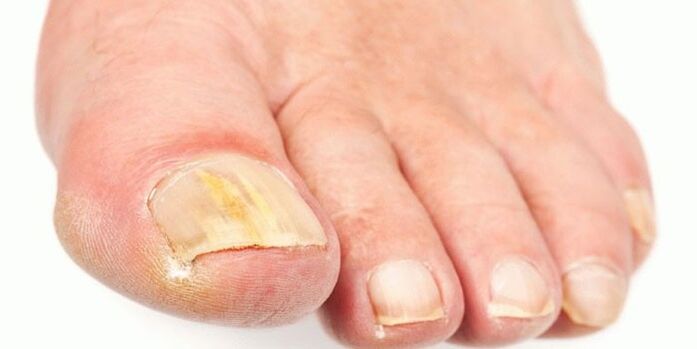 Produits de champignon à ongles efficaces