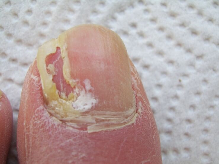 Avec l'onychomycose, une déformation de la plaque à ongles se produit.