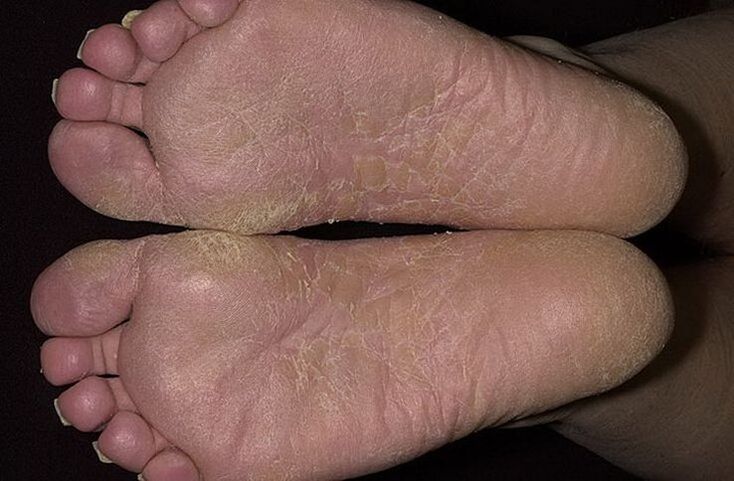 La peau sèche et squameuse des pieds est un signe de mycose squameuse