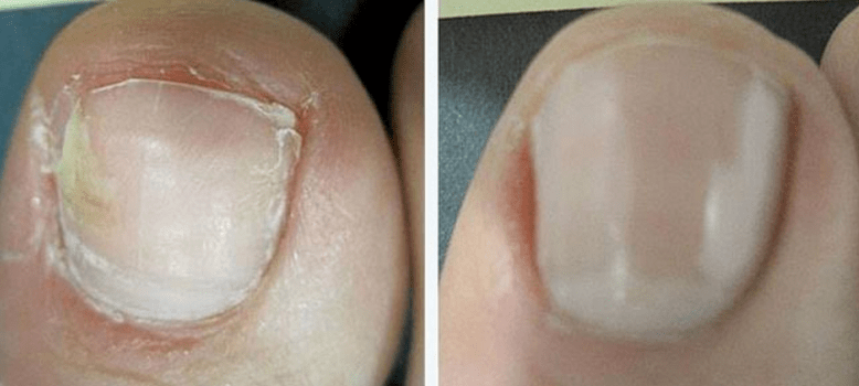 Ongles avant et après traitement fongique.